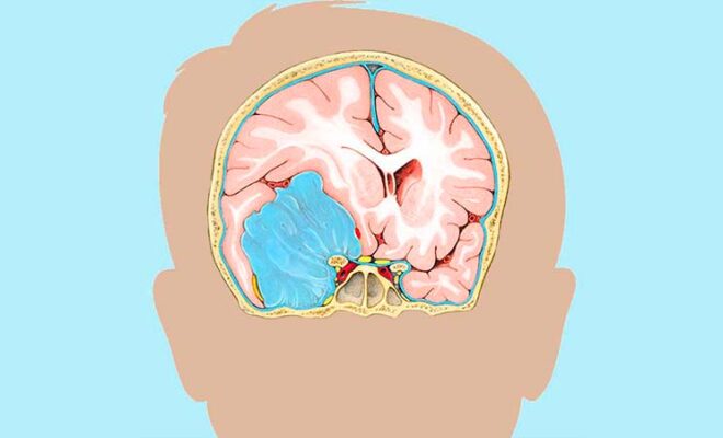 Meningioma Cerebral