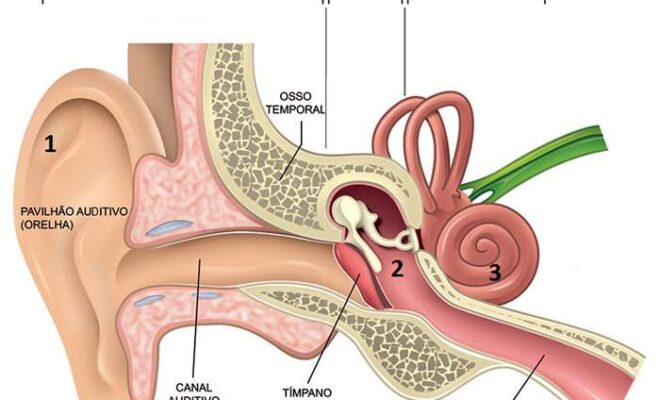 Schwannoma Vestibular